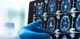 افزایش نظارت بر بیماران آلزایمری تحت درمان Leqembi