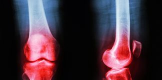 صدمه غضروف، اضافه وزن و انحراف زانو؛ عوامل بروز آرتروز