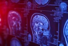 عملکرد موفق داروی آزمایشی SCP۷۷۶ برای بیماران سکته مغزی با دسترسی دیرهنگام به درمان