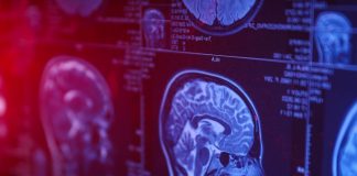 عملکرد موفق داروی آزمایشی SCP۷۷۶ برای بیماران سکته مغزی با دسترسی دیرهنگام به درمان