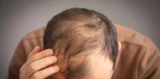 افزایش خطر ریزش مو با داروهای GLP-1 در مردان مستعد طاسی