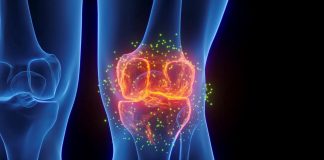 یک داروی صرع در مسیر تازه درمان آرتروز
